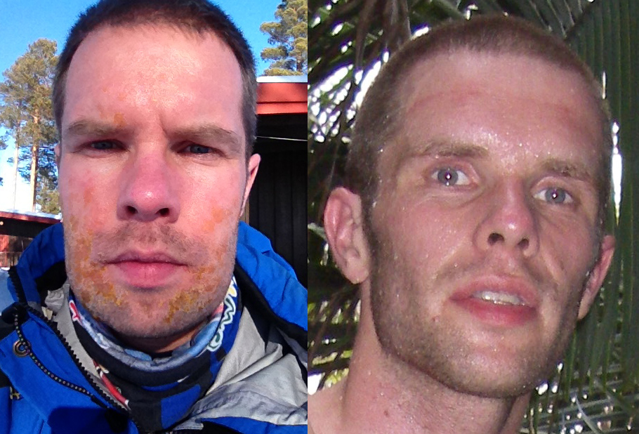 Til venstre - allergisk reaktion på penicillin + børnesår Til højre - efter 3 dages adventurerace i Brasilien. Tabte 5 kg på 5 dage i det løb. 